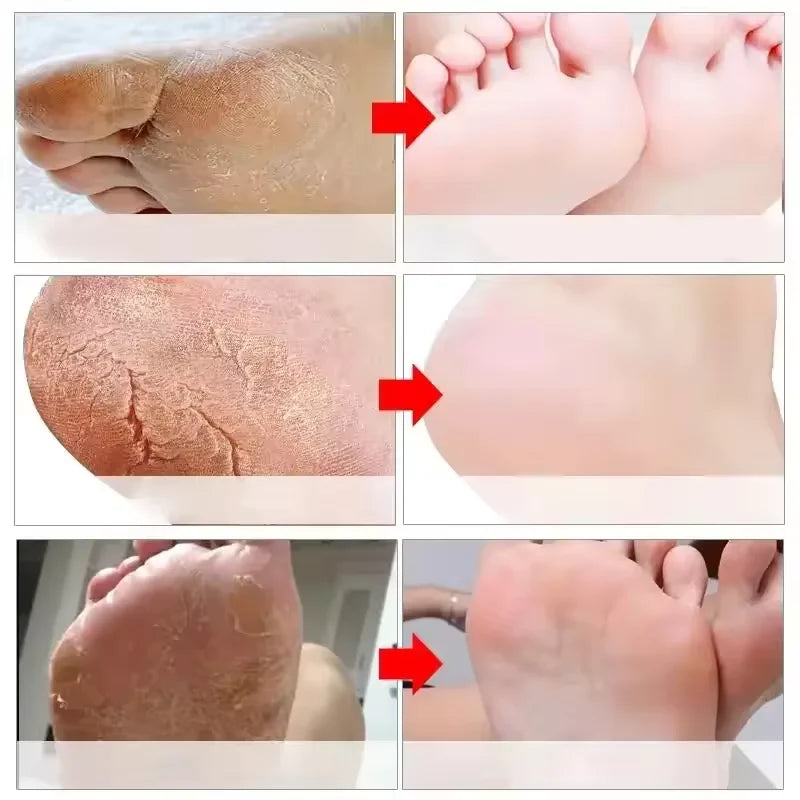 Creme anti-rachadura para pés, spray de ervas para rachaduras no calcanhar, produtos de reparo, esfoliação, remoção de pele morta, suavização, hidratação, cuidados suaves