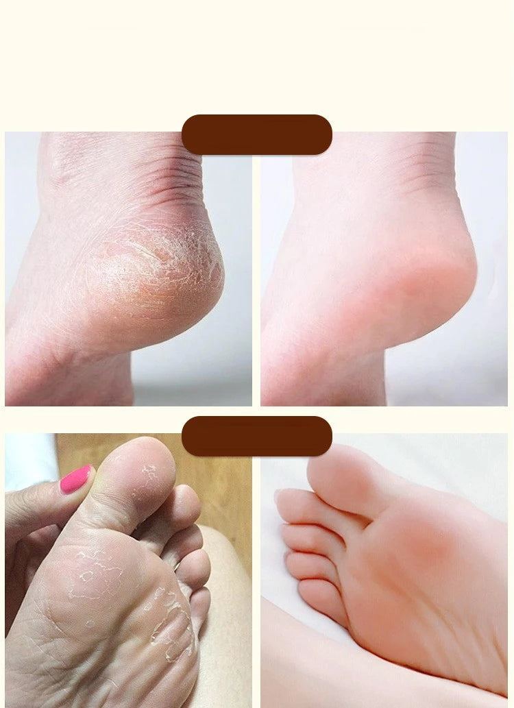Ma You Qing Creme para pés, Creme hidratante para pés, adequado para pele seca, adequado para cuidados com as mãos e pés para mãos e pés secos