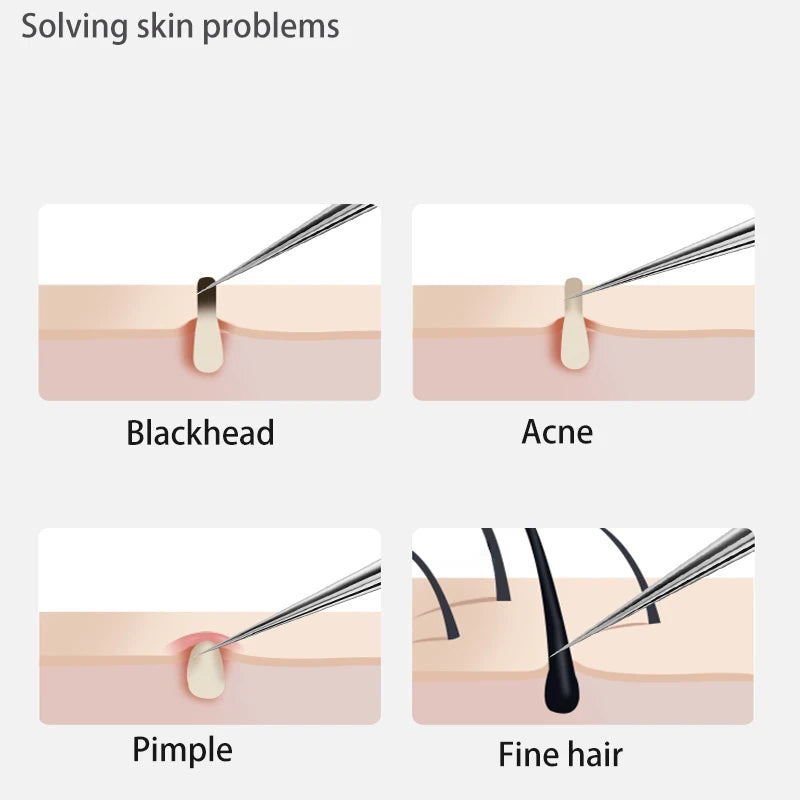 Removedor De Cravos Para Cuidados Com A Pele, Agulha De Acne, Extração De Poros, Black Head Cleaner, Ferramenta De Limpeza, Cell Clamp, 11 Pçs/conjunto